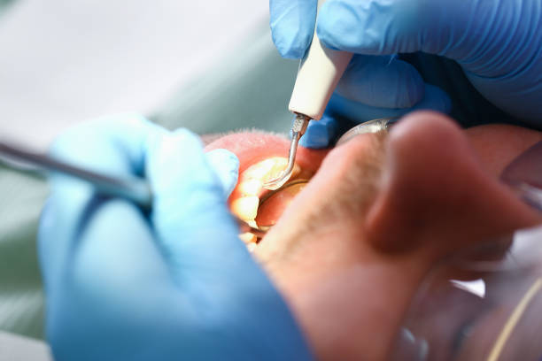 Best Emergency Dental Care for Broken or Chipped Teeth in Cottonwood, AL